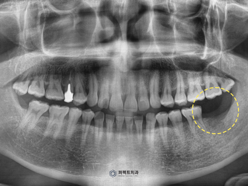 무절개 임플란트, 3분 안에 가능할까? 관련 이미지 2
