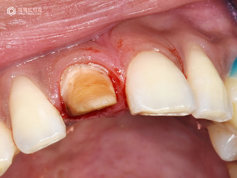 남자라미네이트, 폴리네이트 두가지 케이스 관련 이미지 9
