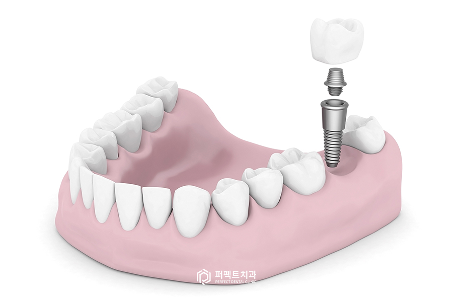 임플란트도 나이 제한이 있다?② - 노인편 관련 이미지 1