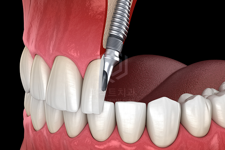 앞니임플란트 시 옆 치아와 색깔을 맞출 수 있을까? 관련 이미지 1