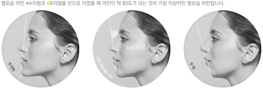 무턱교정으로 어떤 변화가? 과정부터 결과까지! 관련 이미지 3