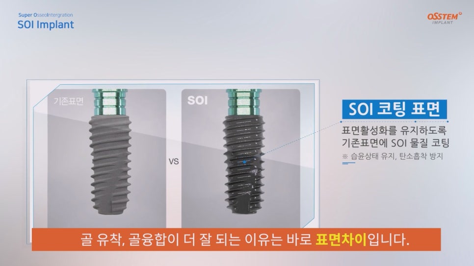 임플란트 종류|좋은 임플란트 고르는 방법은? 관련 이미지 5