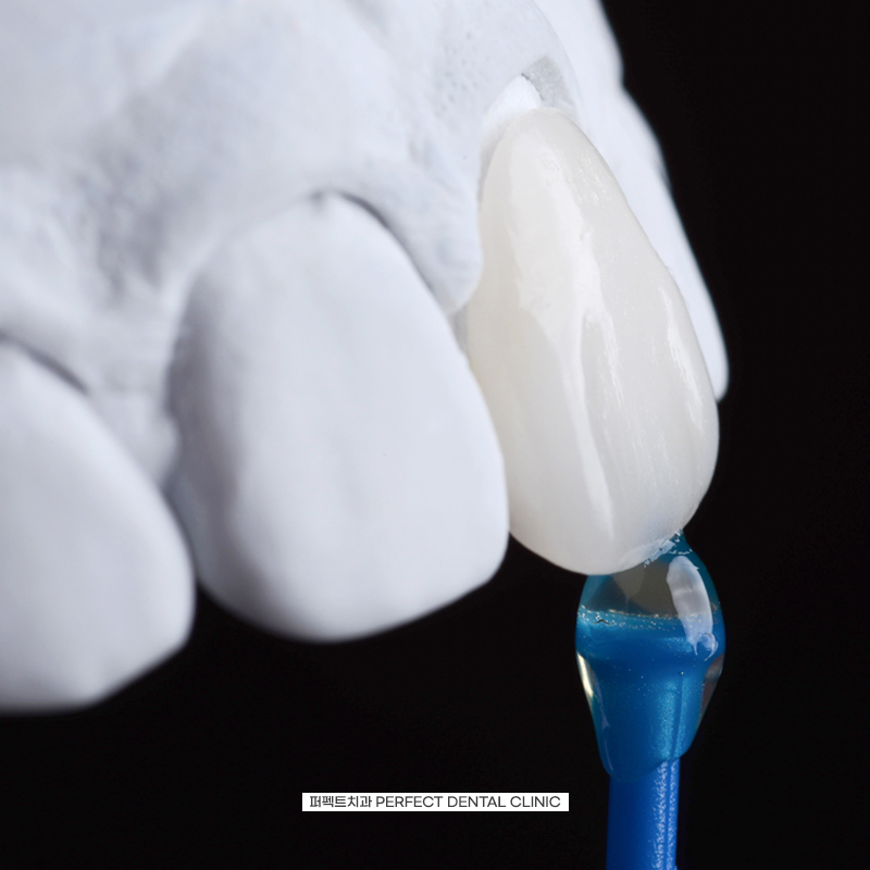 무삭제라미네이트는 어떤 문제점이? 관련 이미지 2