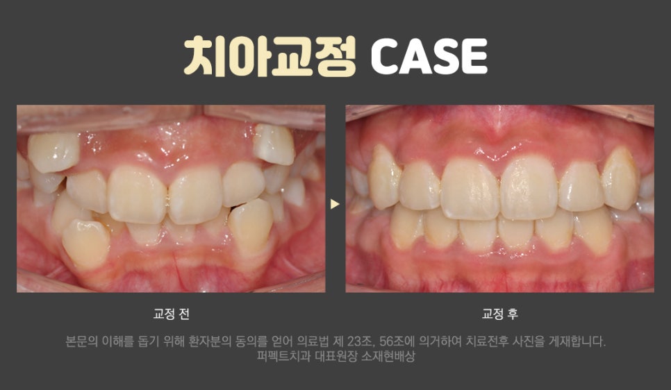 삐뚤빼뚤 덧니를 교정해야 하는 이유는? 관련 이미지 4