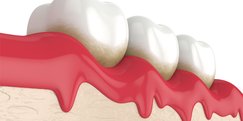 치은염 효과적인 자가요법! 관련 이미지 2
