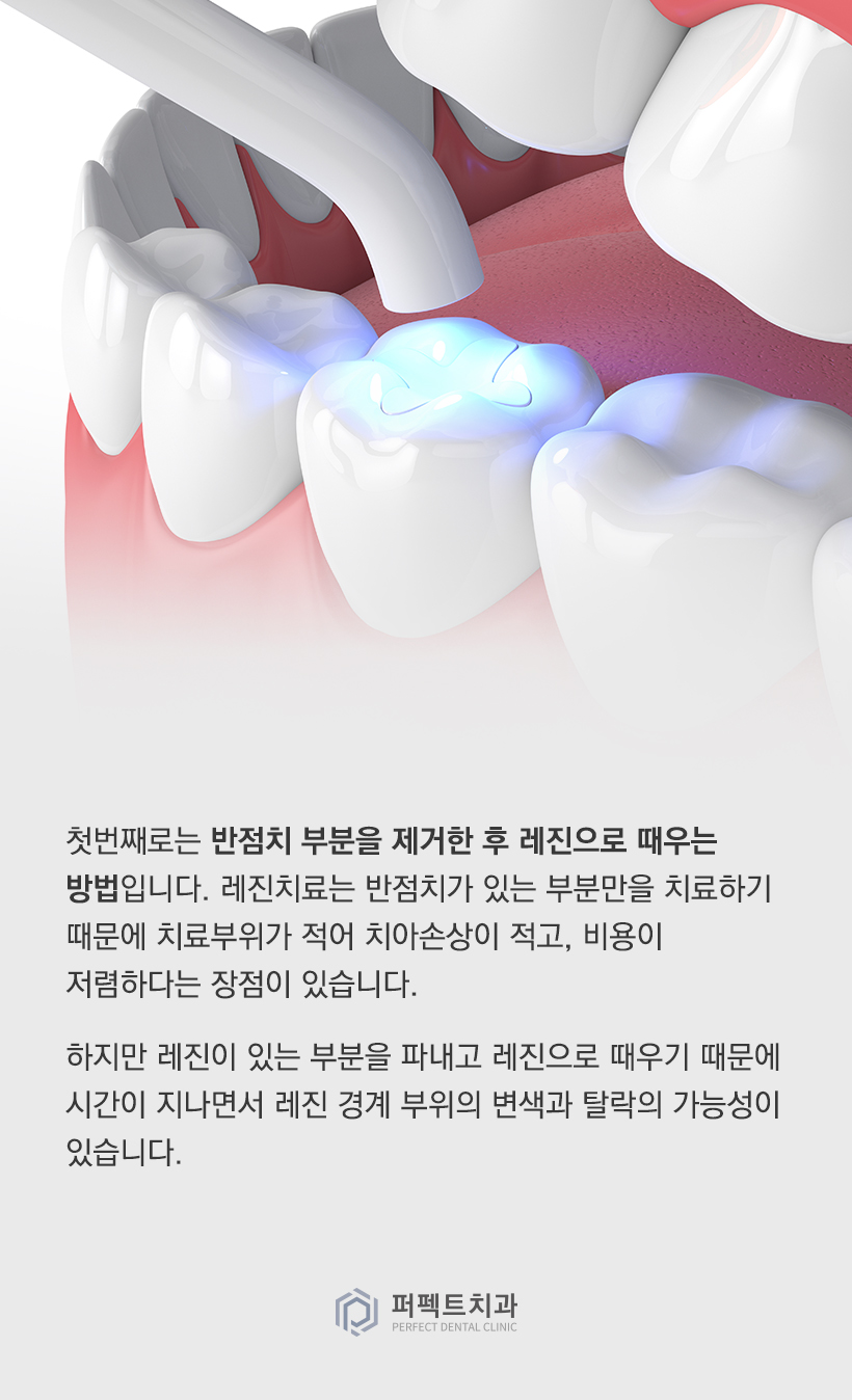 앞니 반점치는 어떻게 치료하나요? 관련 이미지 3