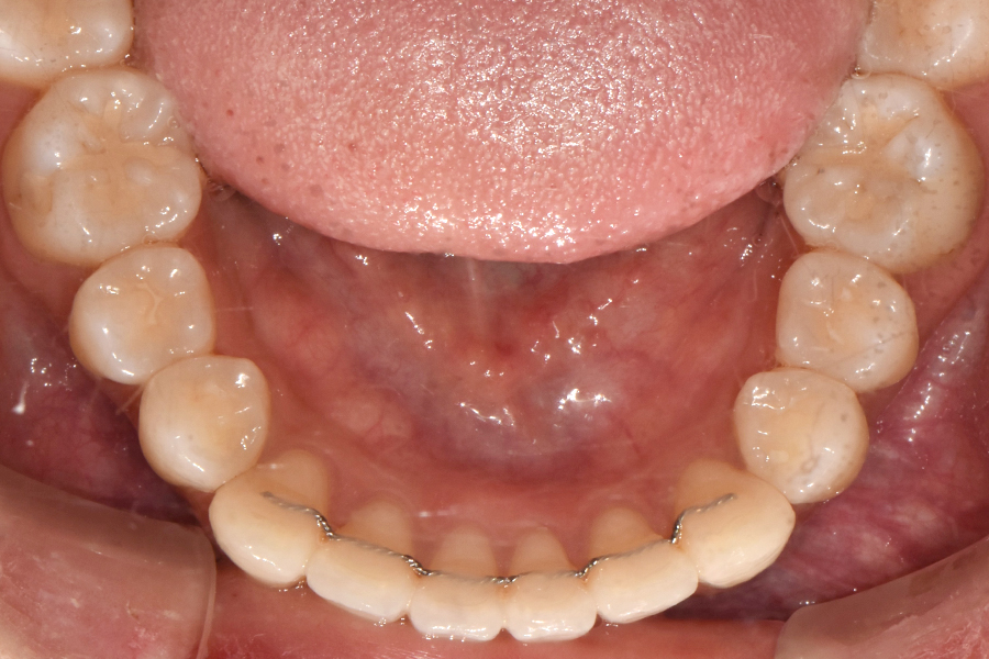 클리피씨를 이용한 부분교정, 얼마나 걸릴까? 관련 이미지 11