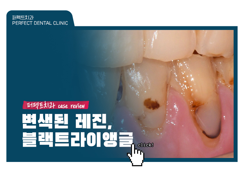 변색된 레진👉라미네이트 교체 관련 이미지 1