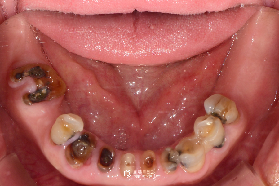 살릴 수 있는 치아가 없다면?❌｜전체임플란트 수복 관련 이미지 11