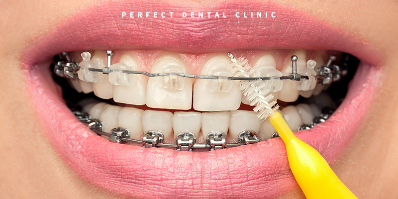 치아교정 중 양치질 중요해요! 관련 이미지 2