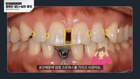 벌어진 앞니 무삭제라미네이트! 관련 이미지 2