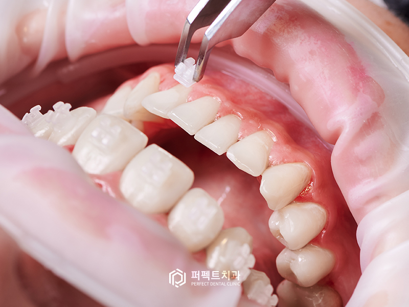 임시치아 시리즈#1 임시치아는 언제 필요한가요? 관련 이미지 2