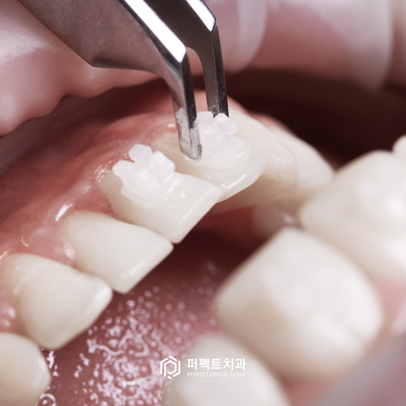 투명교정은 일반교정보다 효과가 떨어지나요? 관련 이미지 2