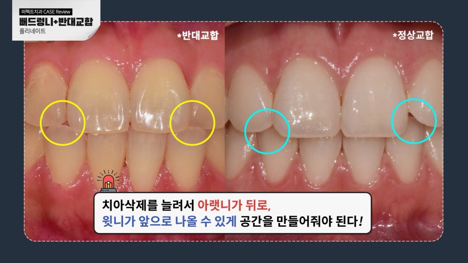 앞니 폴리네이트+치아미백 치료 관련 이미지 4