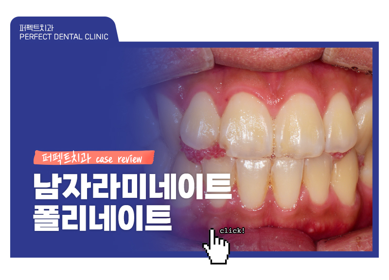 남자라미네이트, 폴리네이트 두가지 케이스 관련 이미지 1