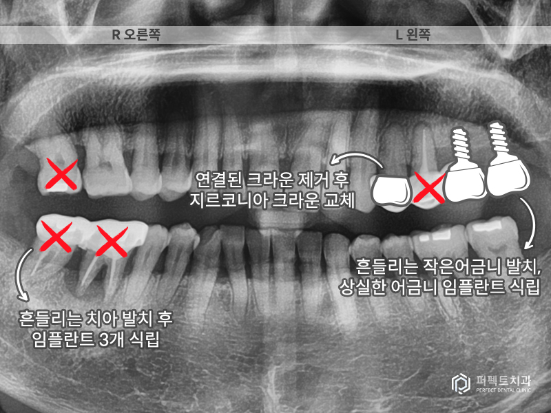 장거리+다수의 임플란트 케이스 관련 이미지 4