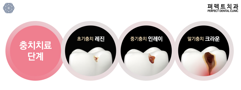 지르코니아 크라운 가격 궁금해? 관련 이미지 2