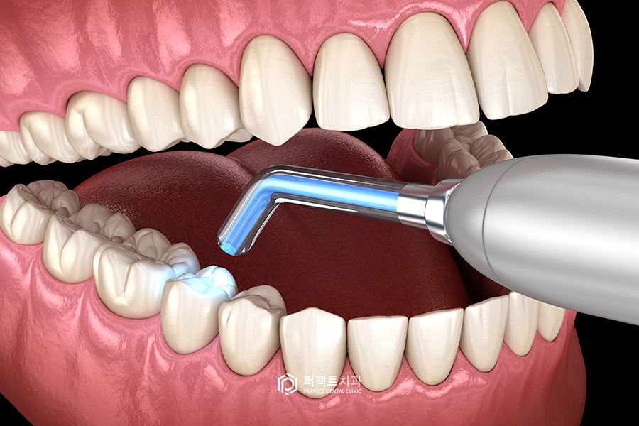 충치치료 후 치아가 시려요!(레진&인레이 치료 후) 관련 이미지 2