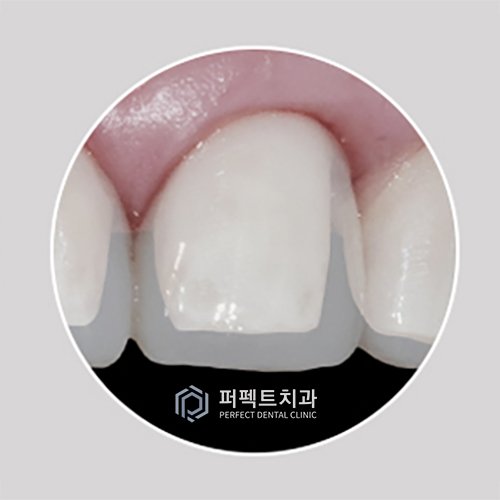 강남치과 무삭제라미네이트비용 관련 이미지 3