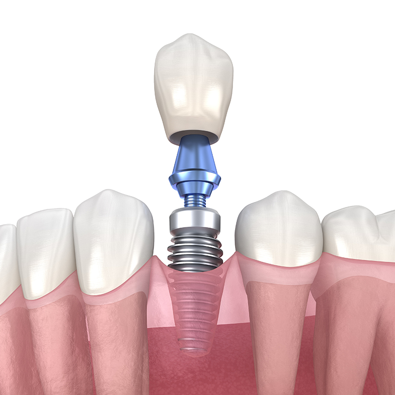 임플란트 한 치아에도 충치가 생길 수 있을까? 관련 이미지 3