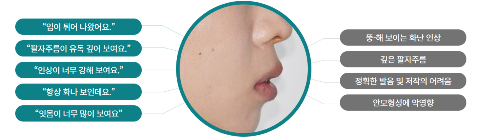 턱을 넓히는 악궁확장장치(MARPE), 왜 사용하는걸까? 관련 이미지 1