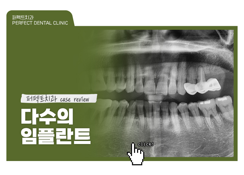 장거리+다수의 임플란트 케이스 관련 이미지 1