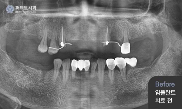 노인임플란트 건강보험 혜택 관련 이미지 3