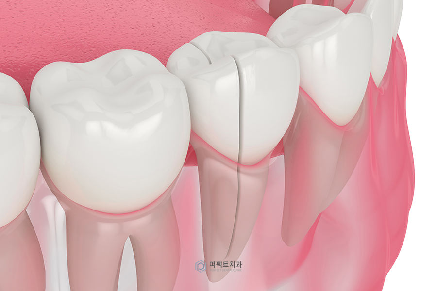 치아에 금이 갔어요|예방법과 치료방법은? 관련 이미지 3