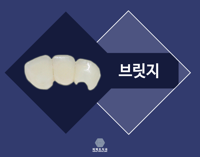 상실한 치아 찾고 싶은데 보철치료 종류에는? 관련 이미지 4