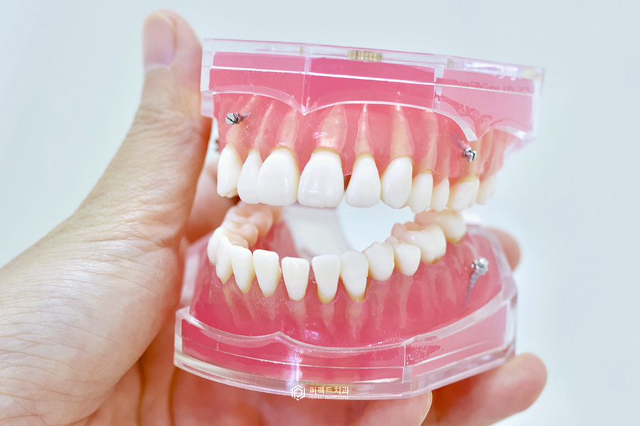 미니스크류｜치아교정 시 잇몸에 심는 나사는? 관련 이미지 3