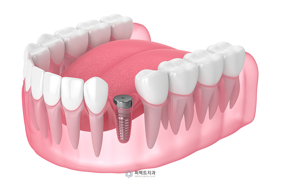 임플란트 후 임시치아, 임시틀니① 관련 이미지 1