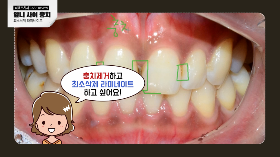 앞니 사이 충치, 어떻게 치료해야 티 안 날까? 관련 이미지 3