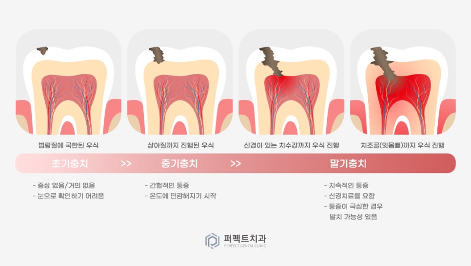 미룰수록 어려운 충치치료, 초기에 치료해요! 관련 이미지 3
