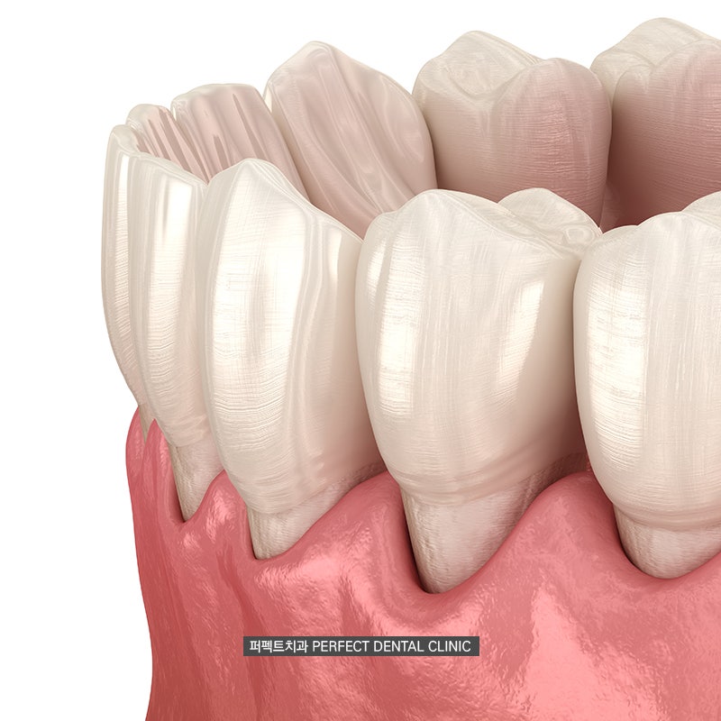 임플란트시 뼈이식이 필요한 경우 관련 이미지 4