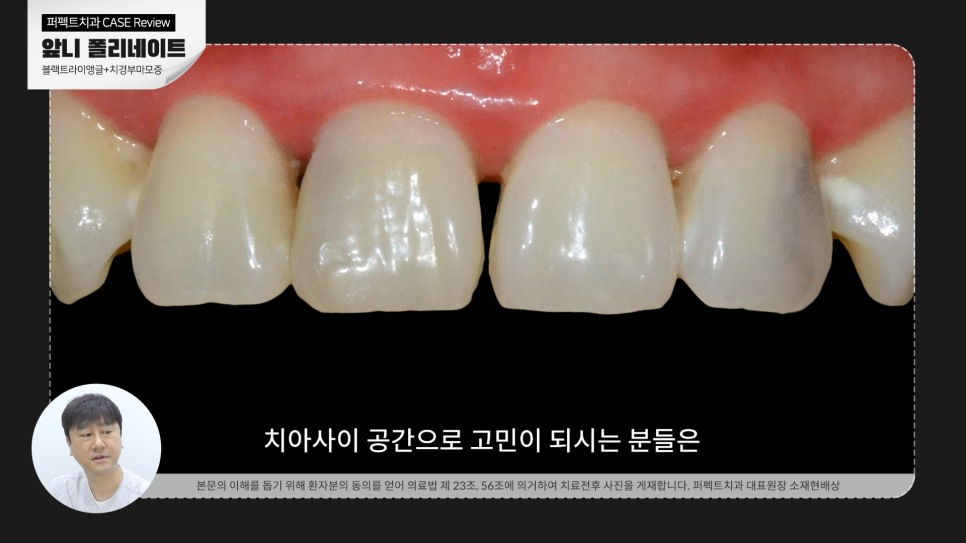 앞니 사이 틈, 블랙트라이앵글 치료방법 어렵지 않아요. 관련 이미지 2