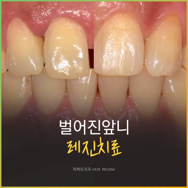 벌어진 앞니 간단하게 치료하고싶다면?! 관련 이미지 1