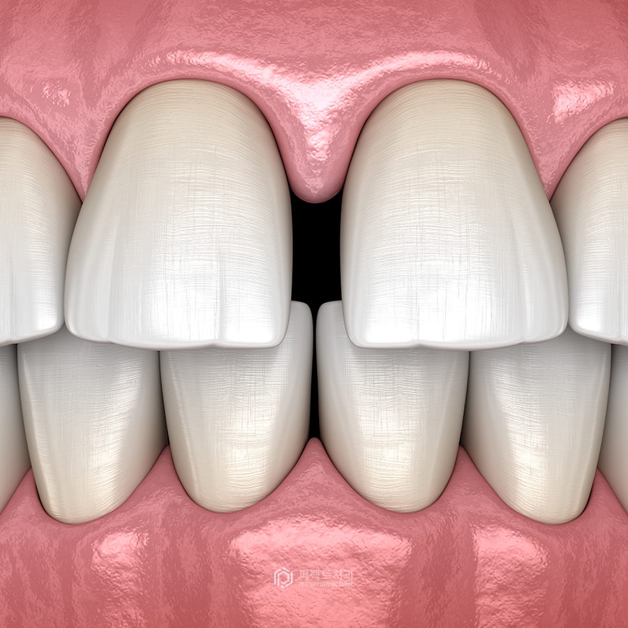 벌어진 앞니 치료 방법은? 관련 이미지 5