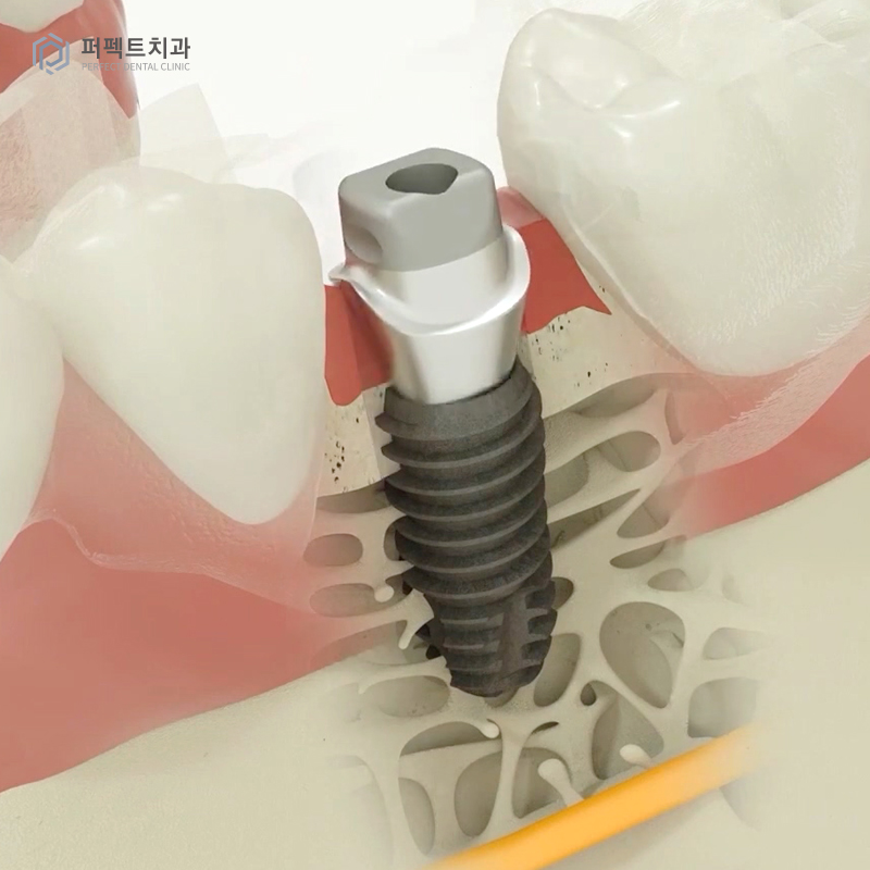 네비게이션 임플란트란? 관련 이미지 2
