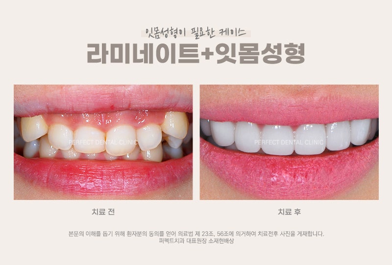 라미네이트시 잇몸성형 해야되나요? 관련 이미지 3