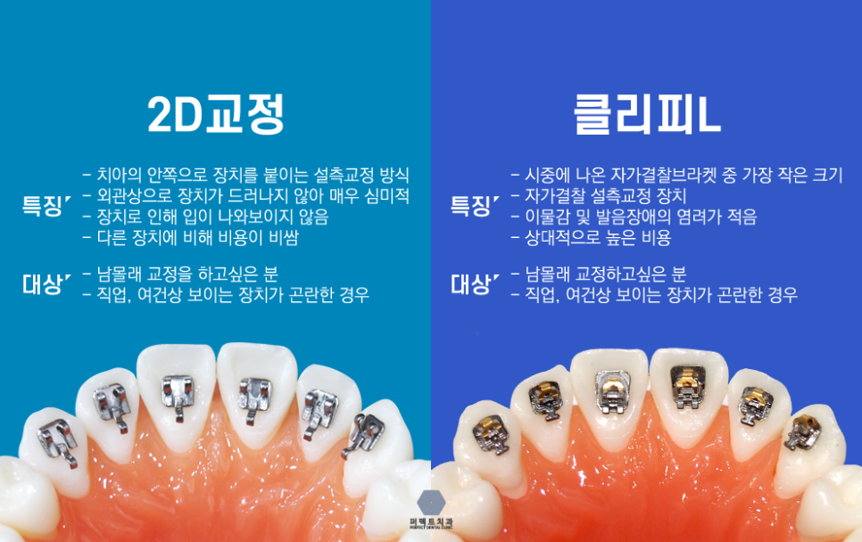 치아안쪽에 하는 설측교정^^ 관련 이미지 4