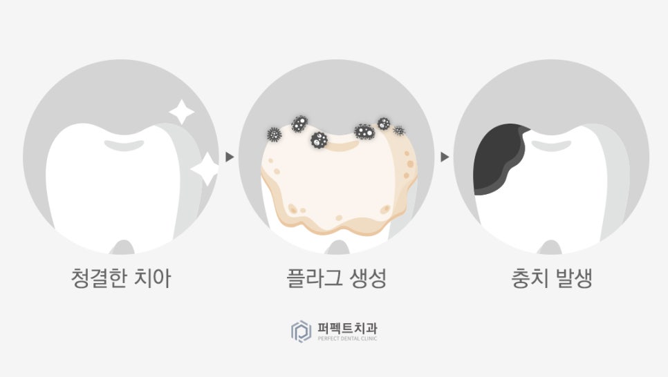 미룰수록 어려운 충치치료, 초기에 치료해요! 관련 이미지 2