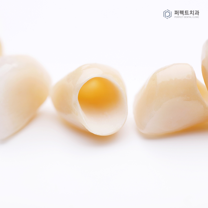 크라운 교체 시기는? 관련 이미지 3