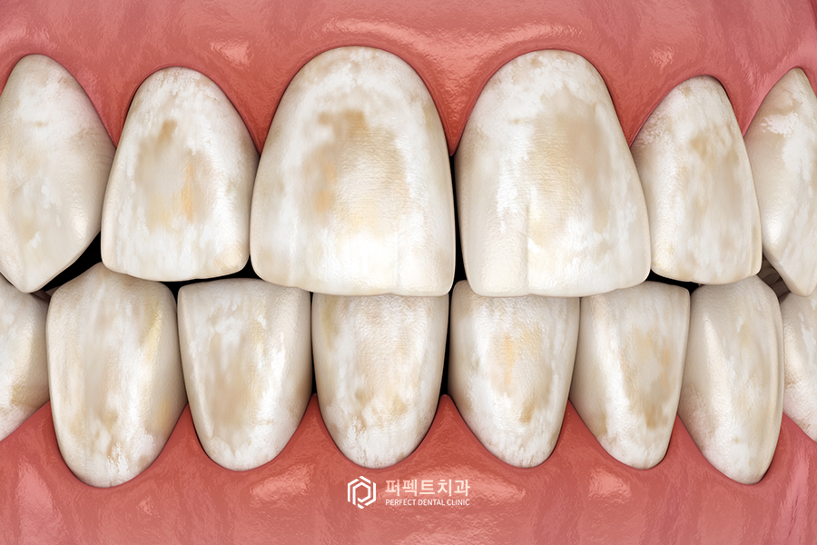 앞니 반점치, 치료 할 수 있는 방법은? 관련 이미지 1