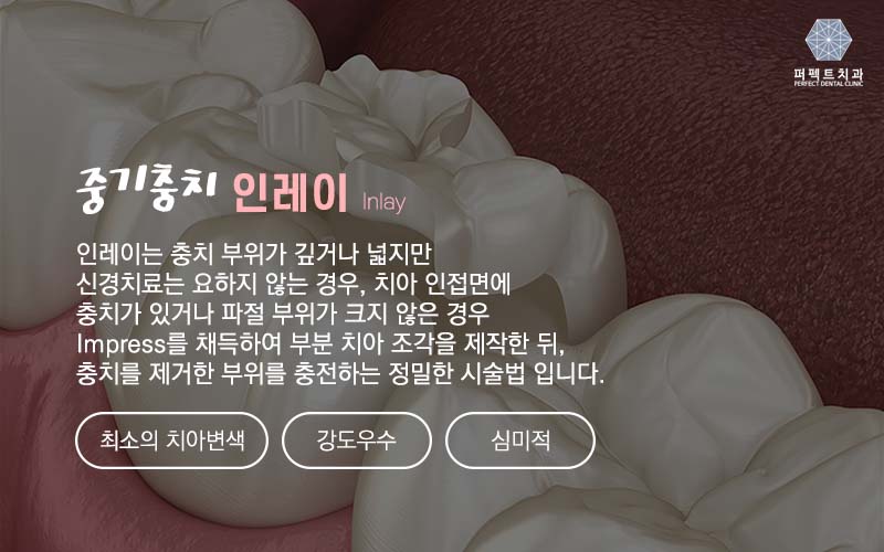 강남치과 충치 인레이 비용 관련 이미지 1