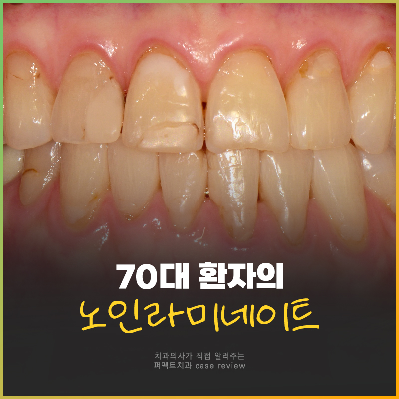 70대도 라미네이트가 가능하다구요? 관련 이미지 1