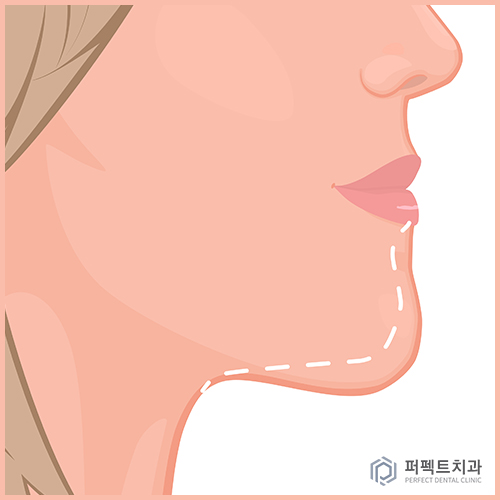 비수술 주걱턱 교정 결과는? 관련 이미지 1