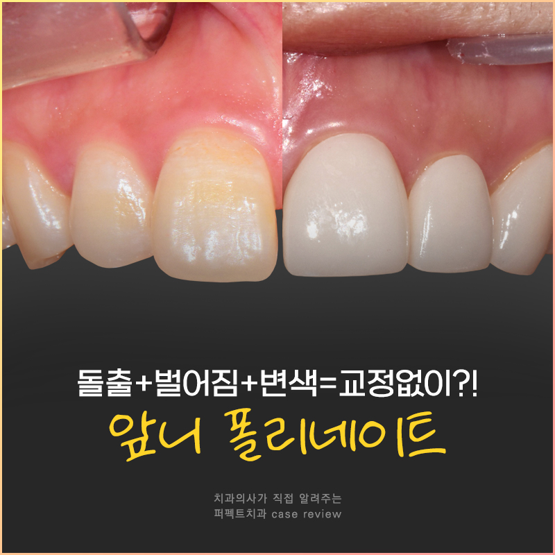 앞니 돌출 있는데 폴리네이트로 극복 가능..?🤔 관련 이미지 1