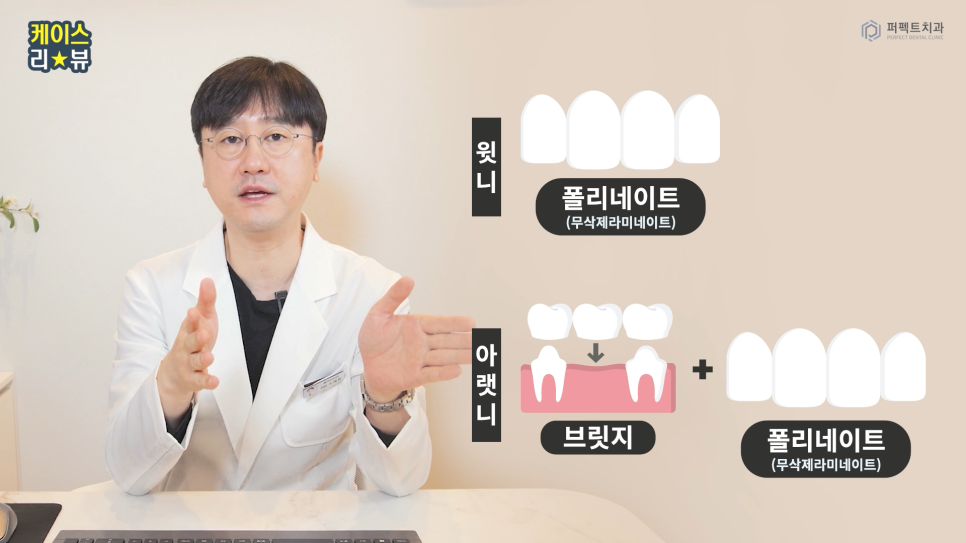 앞니충치, 벌어짐 동시에 치료하는 방법 관련 이미지 3
