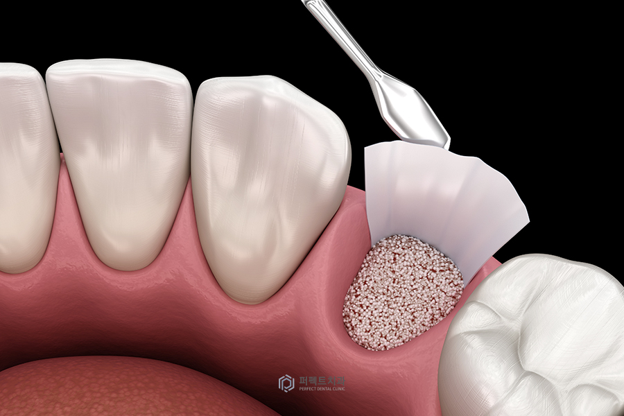 임플란트 시 꼭 뼈이식을 해야할까? 관련 이미지 1