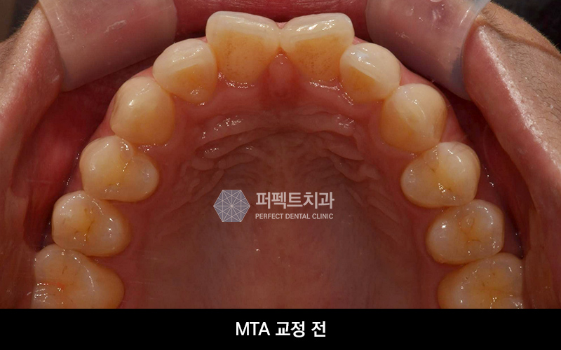 3개월 단기교정 비용과 기간은? 관련 이미지 2